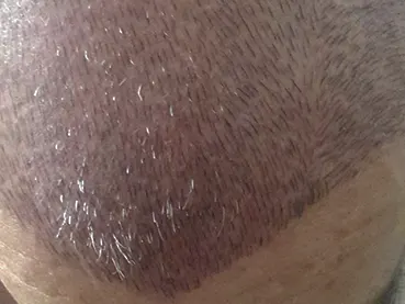 Resultado de micropigmentación capilar
